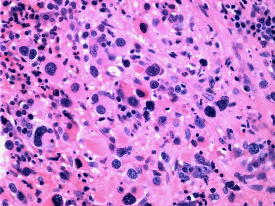 Megakaryocytes are markedly increased and atypical.
